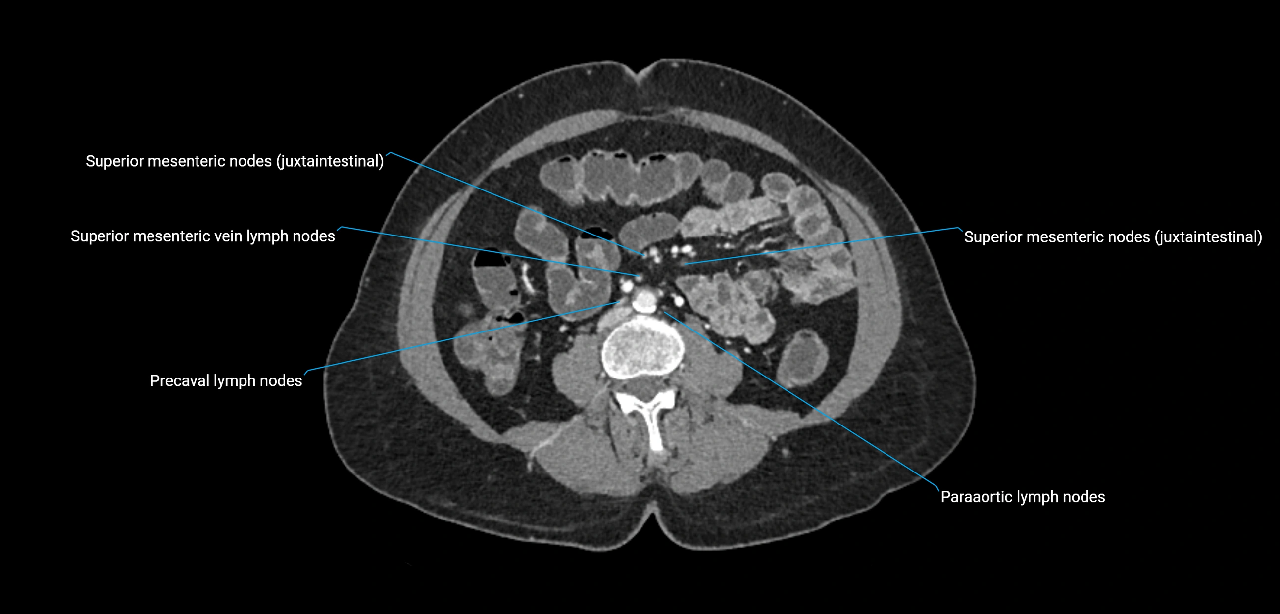 CT ct abdominal lymph nodes  axial cross sectional anatomy  enchanced radiology image -img-00002-00246.webp